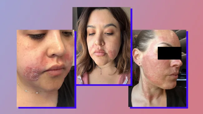 Morpheus8 treatment left us with swelling and blisters for weeks — it wasn’t worth the potential results