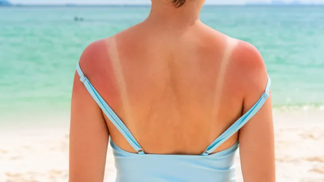 8 ways to help soothe your painful heatwave sunburn