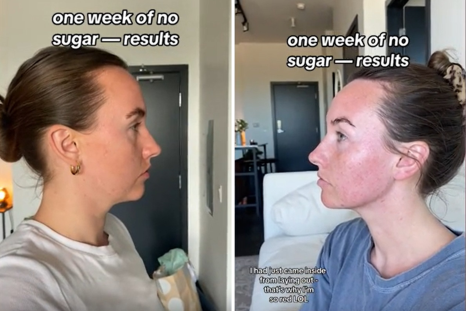 Woman Shares How Her Jawline Reappeared After Just 'One Week of No Sugar'