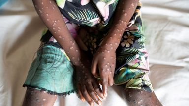 Mpox outbreak declared public health emergency in Africa