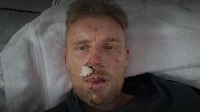 Freddie Flintoff reveals extent of injuries after Top Gear crash