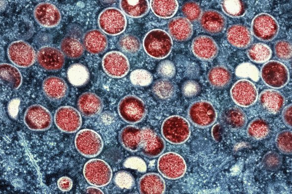 Sweden Reports First Case of Mpox Strain Outside of Africa