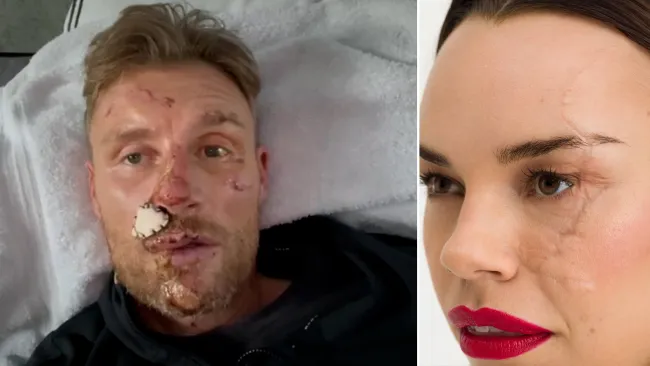 I think Freddie Flintoff’s facial scars look cool – and they’re just like mine