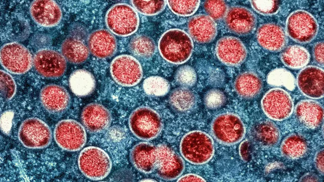 Mpox virus 2024: Thailand confirms case as dangerous new variant spreads