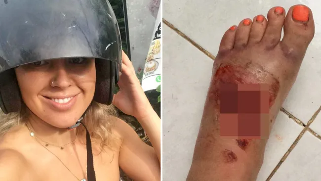 British tourist almost loses foot after being impaled in moped crash