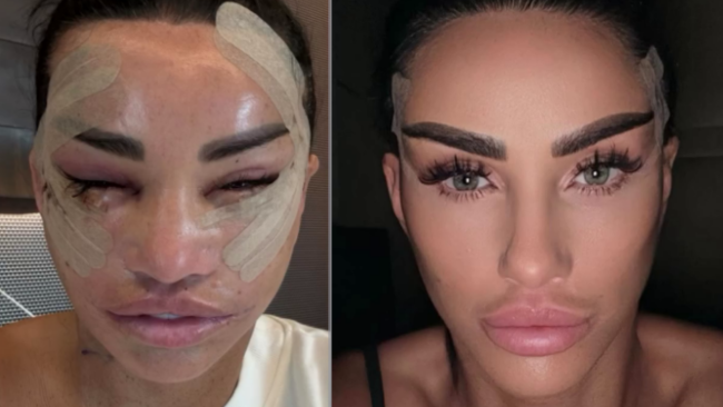 Katie Price urges fans to ‘trust the process’ by sharing shocking photos of facelift recovery