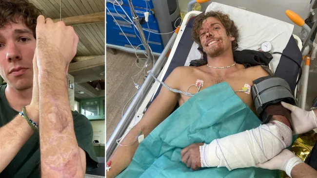 Shark attack survivor will turn tooth pulled out of his severed arm into earring