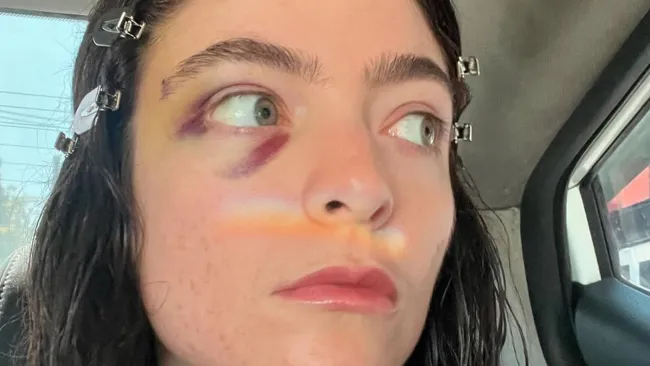 Lorde sparks concern with black eye in cryptic social media return